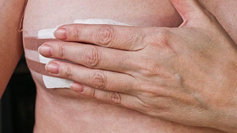 Breast Conserving Surgery
